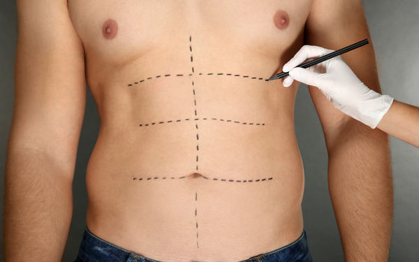 Six Pack Surgery
